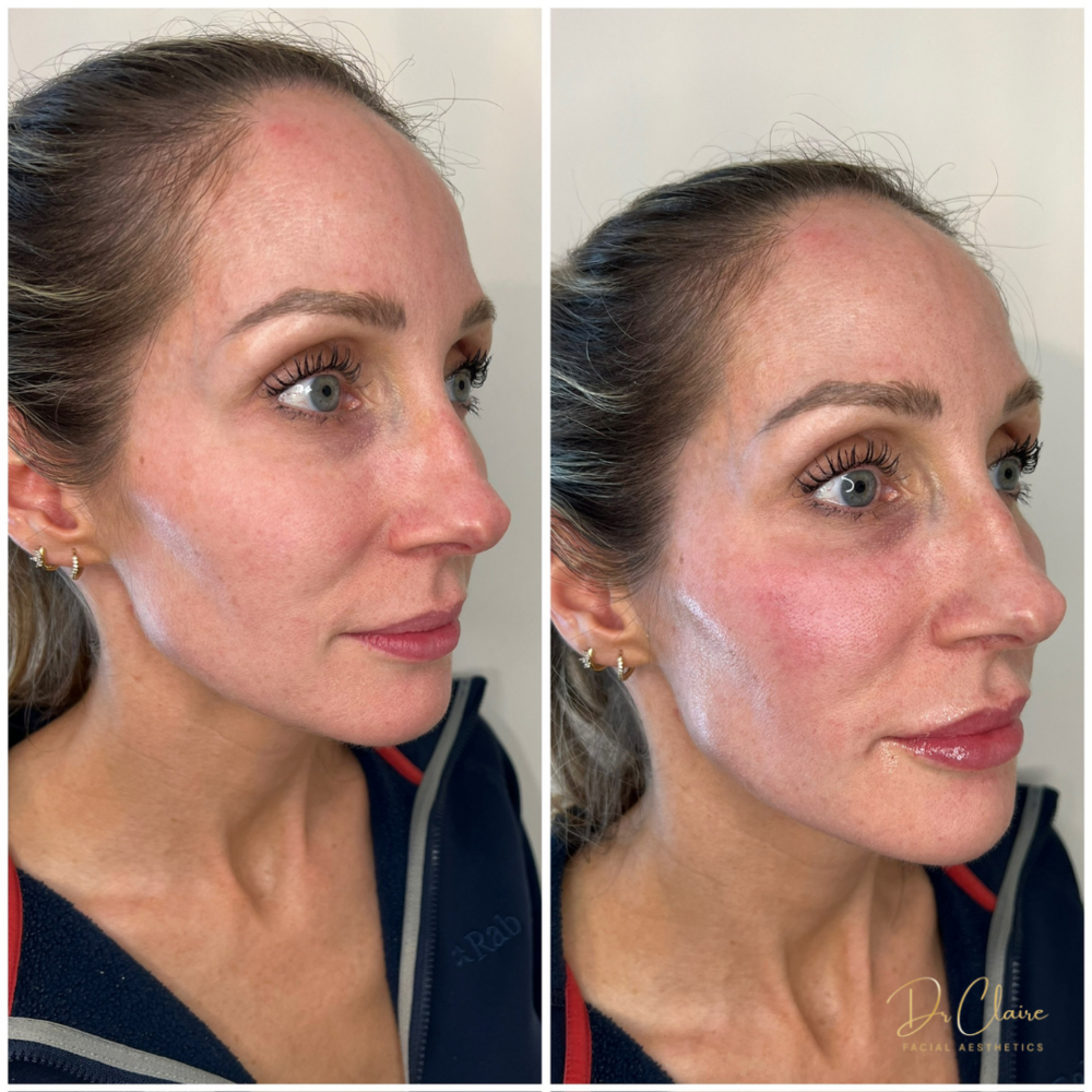 Transformations | Dr Claire Facial Aesthetics | Botox Chorley | Fillers Chorley | Aesthetics Chorley | Botox Treatments Chorley | Dermal Fillers Chorley | Aesthetic Enhancements Chorley