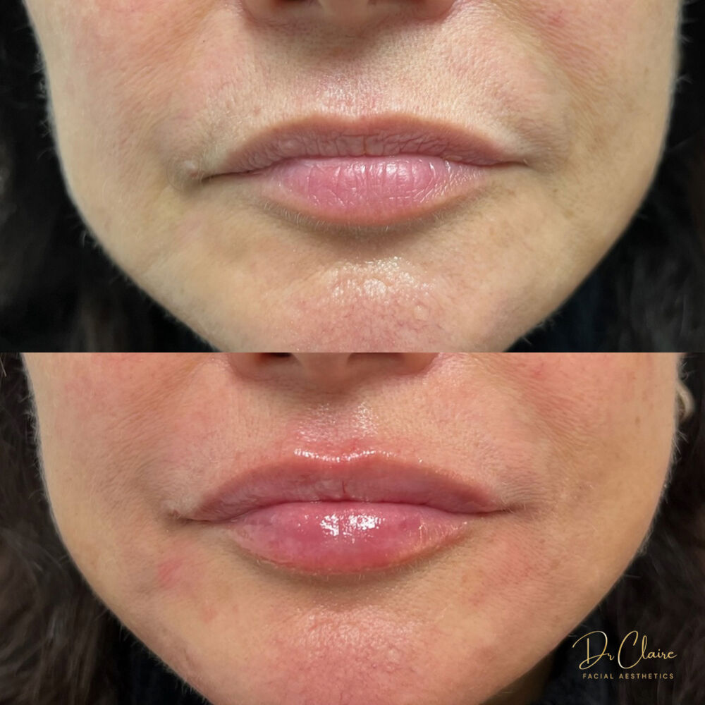 Transformations | Dr Claire Facial Aesthetics | Botox Chorley | Fillers Chorley | Aesthetics Chorley | Botox Treatments Chorley | Dermal Fillers Chorley | Aesthetic Enhancements Chorley