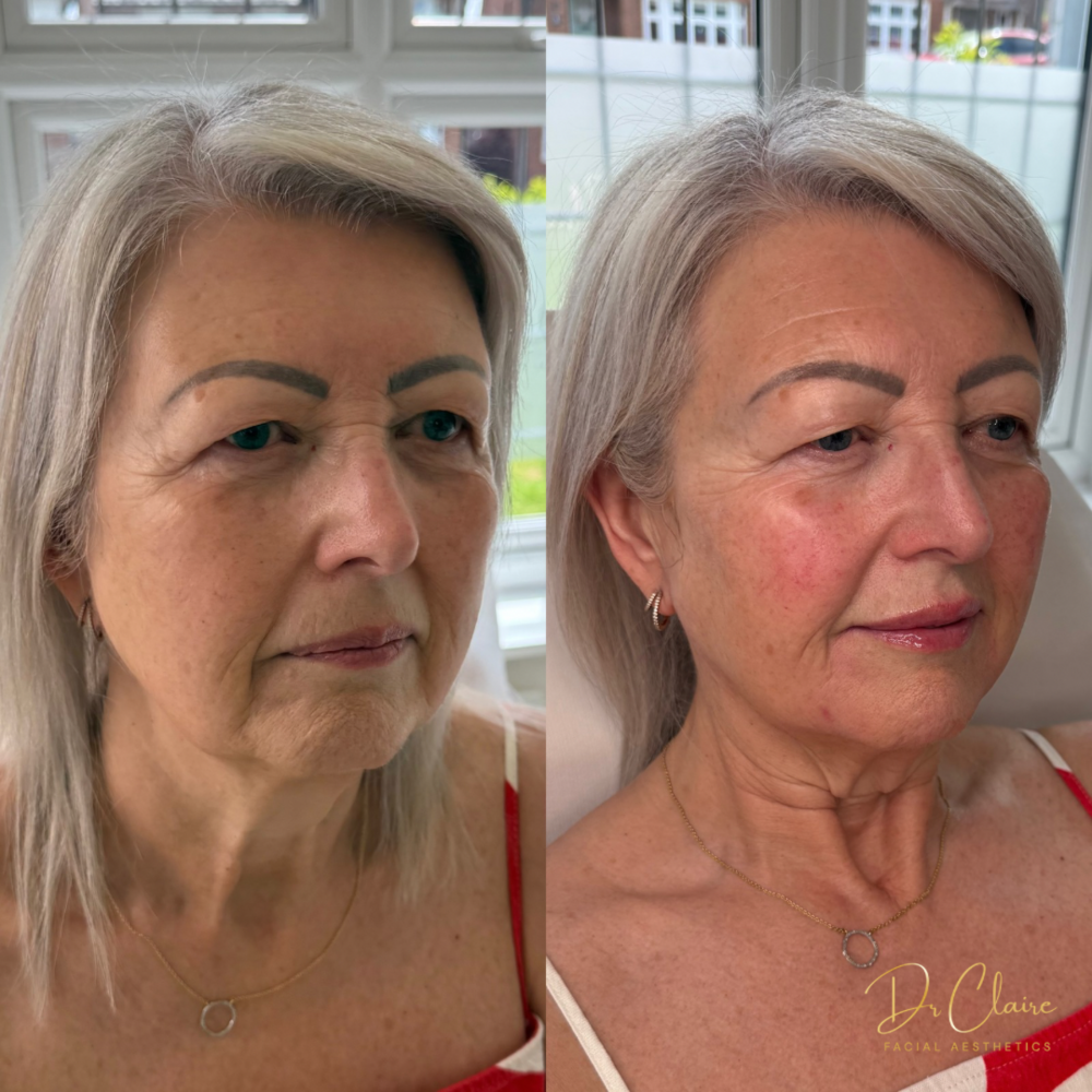 Transformations | Dr Claire Facial Aesthetics | Botox Chorley | Fillers Chorley | Aesthetics Chorley | Botox Treatments Chorley | Dermal Fillers Chorley | Aesthetic Enhancements Chorley