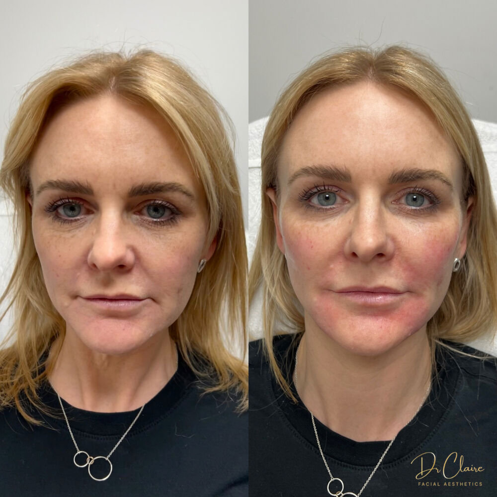 Transformations | Dr Claire Facial Aesthetics | Botox Chorley | Fillers Chorley | Aesthetics Chorley | Botox Treatments Chorley | Dermal Fillers Chorley | Aesthetic Enhancements Chorley
