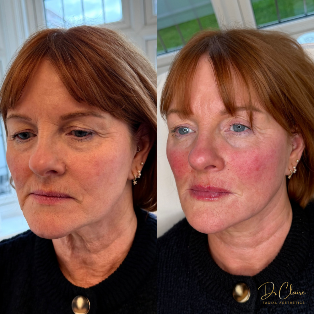 Transformations | Dr Claire Facial Aesthetics | Botox Chorley | Fillers Chorley | Aesthetics Chorley | Botox Treatments Chorley | Dermal Fillers Chorley | Aesthetic Enhancements Chorley
