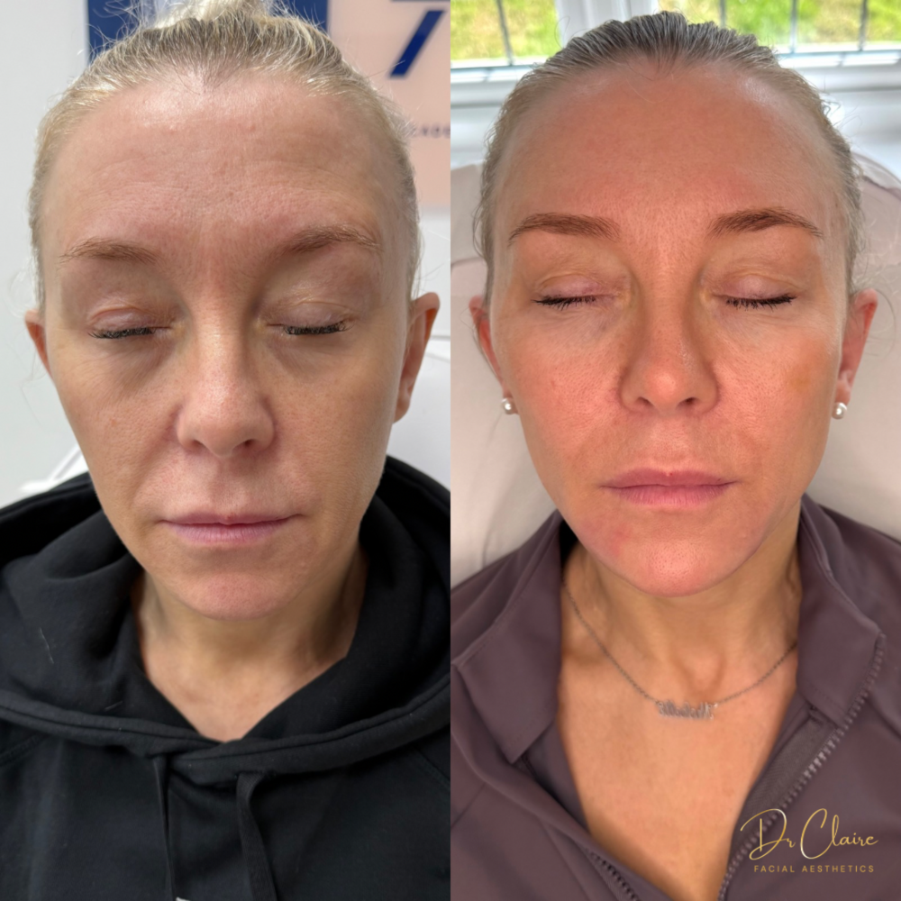 Transformations | Dr Claire Facial Aesthetics | Botox Chorley | Fillers Chorley | Aesthetics Chorley | Botox Treatments Chorley | Dermal Fillers Chorley | Aesthetic Enhancements Chorley