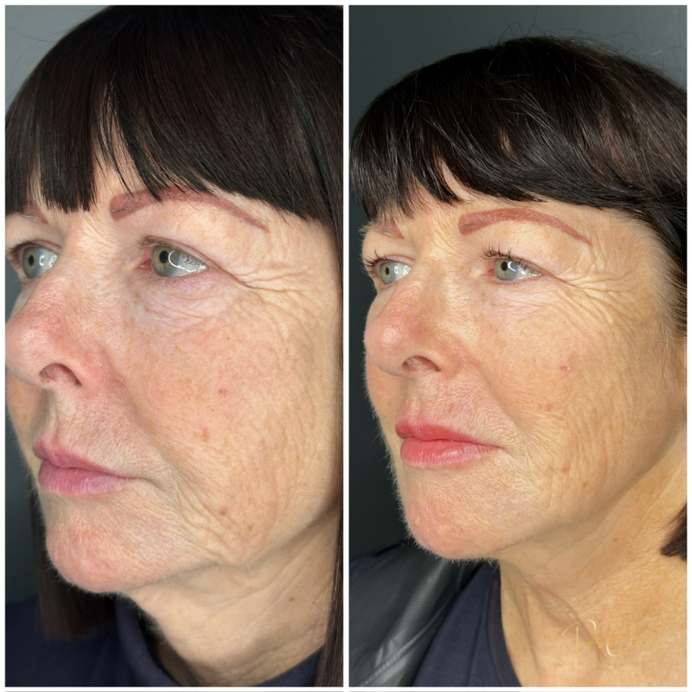 Transformations | Dr Claire Facial Aesthetics | Botox Chorley | Fillers Chorley | Aesthetics Chorley | Botox Treatments Chorley | Dermal Fillers Chorley | Aesthetic Enhancements Chorley