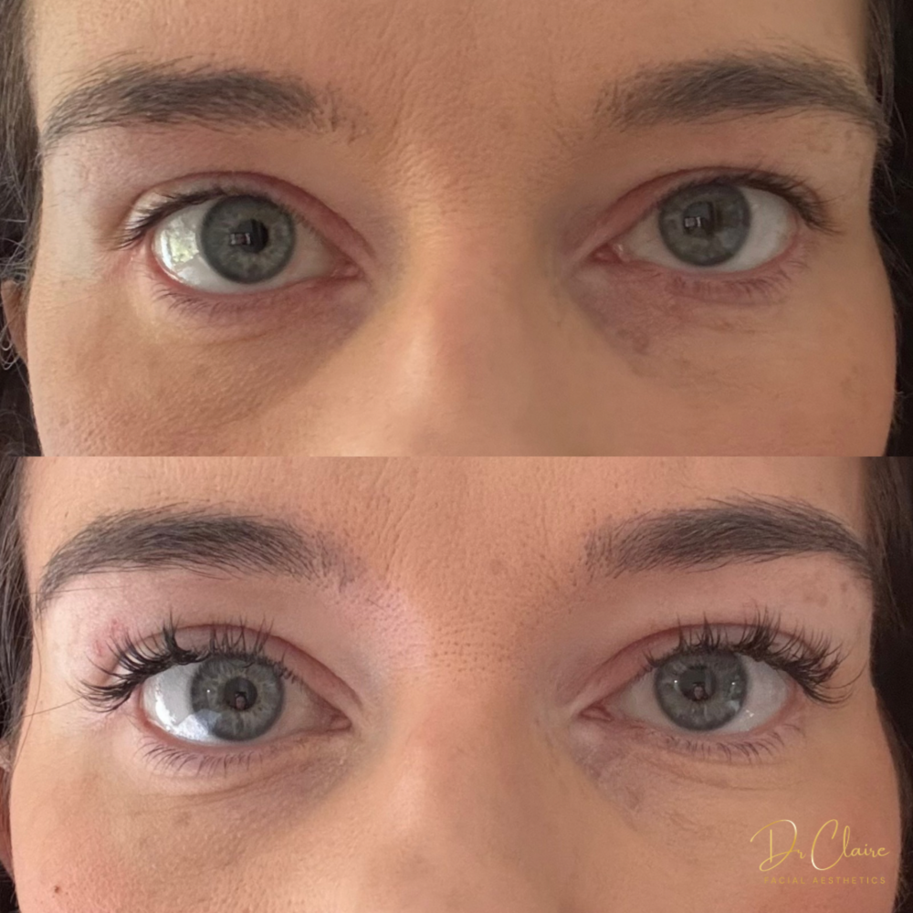 Transformations | Dr Claire Facial Aesthetics | Botox Chorley | Fillers Chorley | Aesthetics Chorley | Botox Treatments Chorley | Dermal Fillers Chorley | Aesthetic Enhancements Chorley