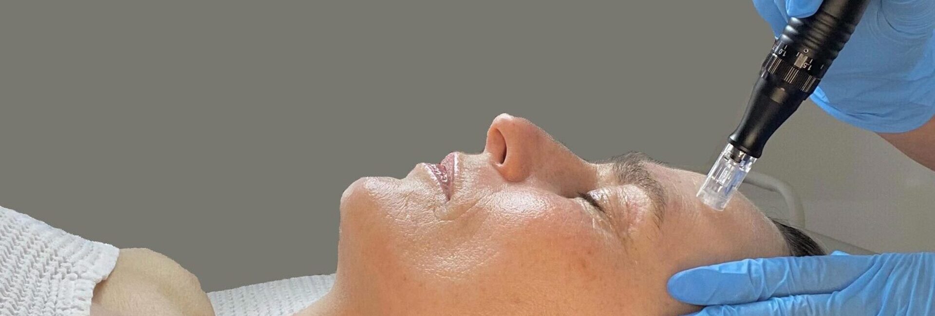 Facial Acupuncture Bromley