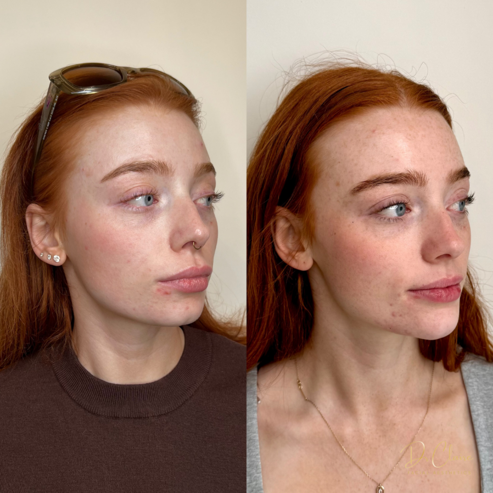 Transformations | Dr Claire Facial Aesthetics | Botox Chorley | Fillers Chorley | Aesthetics Chorley | Botox Treatments Chorley | Dermal Fillers Chorley | Aesthetic Enhancements Chorley