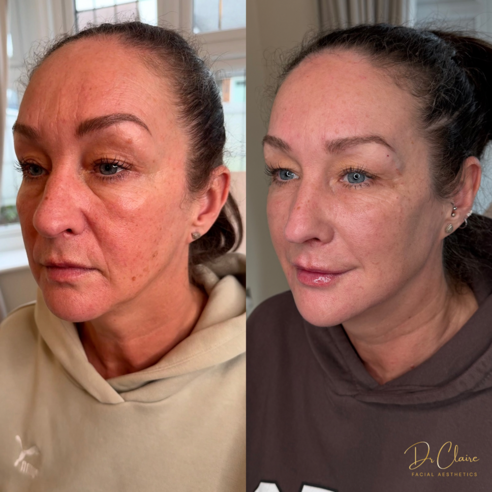Transformations | Dr Claire Facial Aesthetics | Botox Chorley | Fillers Chorley | Aesthetics Chorley | Botox Treatments Chorley | Dermal Fillers Chorley | Aesthetic Enhancements Chorley
