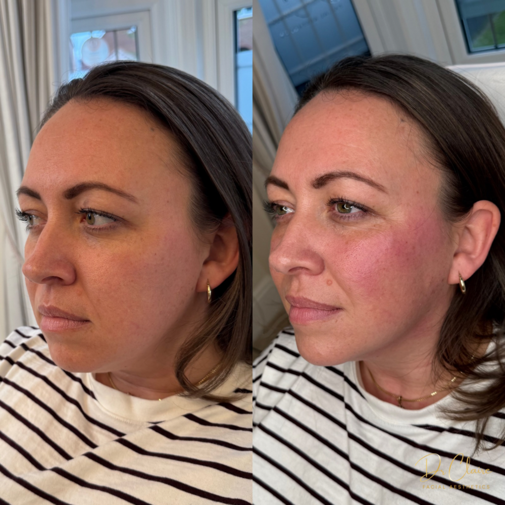 Transformations | Dr Claire Facial Aesthetics | Botox Chorley | Fillers Chorley | Aesthetics Chorley | Botox Treatments Chorley | Dermal Fillers Chorley | Aesthetic Enhancements Chorley