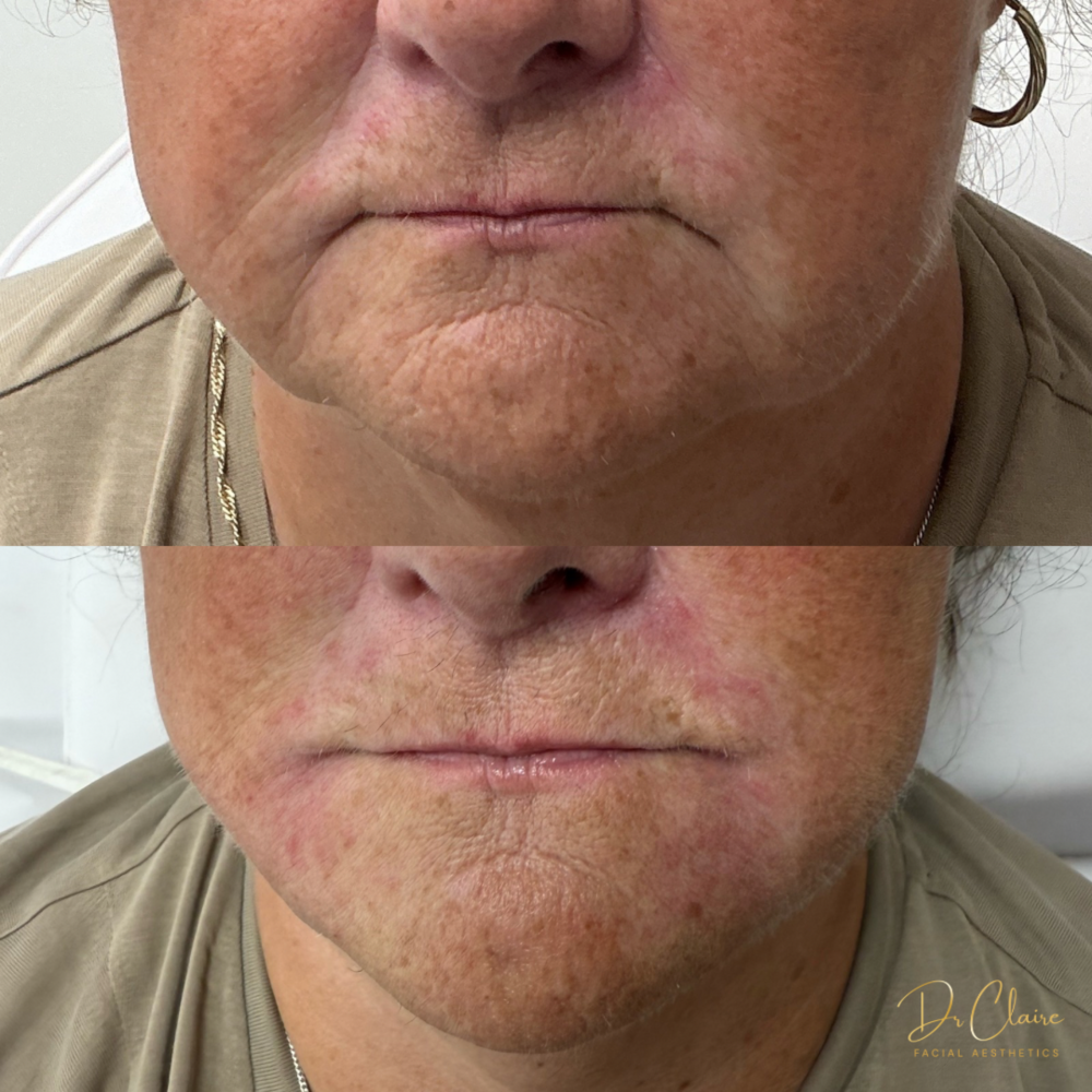 Transformations | Dr Claire Facial Aesthetics | Botox Chorley | Fillers Chorley | Aesthetics Chorley | Botox Treatments Chorley | Dermal Fillers Chorley | Aesthetic Enhancements Chorley