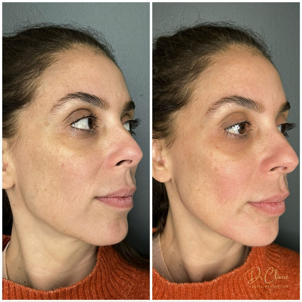 Transformations | Dr Claire Facial Aesthetics | Botox Chorley | Fillers Chorley | Aesthetics Chorley | Botox Treatments Chorley | Dermal Fillers Chorley | Aesthetic Enhancements Chorley
