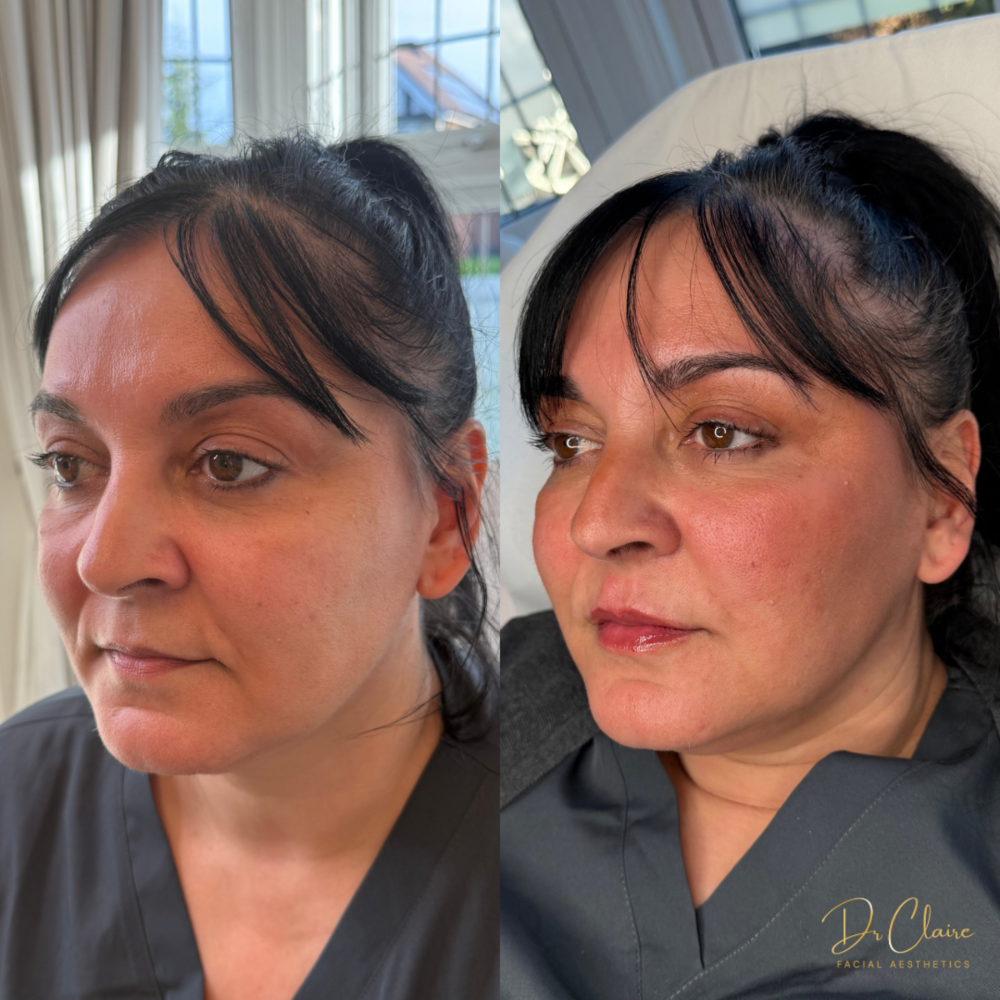 Transformations | Dr Claire Facial Aesthetics | Botox Chorley | Fillers Chorley | Aesthetics Chorley | Botox Treatments Chorley | Dermal Fillers Chorley | Aesthetic Enhancements Chorley
