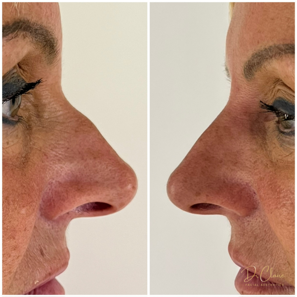 Transformations | Dr Claire Facial Aesthetics | Botox Chorley | Fillers Chorley | Aesthetics Chorley | Botox Treatments Chorley | Dermal Fillers Chorley | Aesthetic Enhancements Chorley