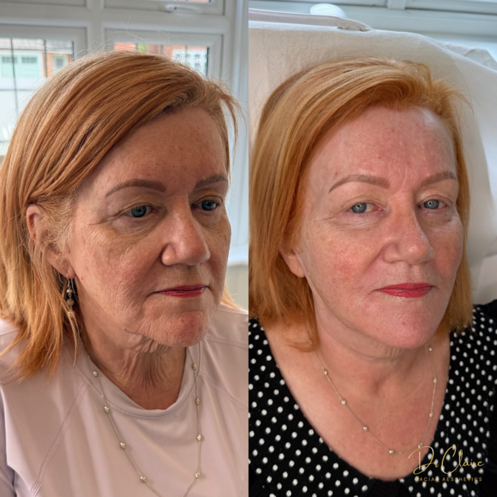 Transformations | Dr Claire Facial Aesthetics | Botox Chorley | Fillers Chorley | Aesthetics Chorley | Botox Treatments Chorley | Dermal Fillers Chorley | Aesthetic Enhancements Chorley