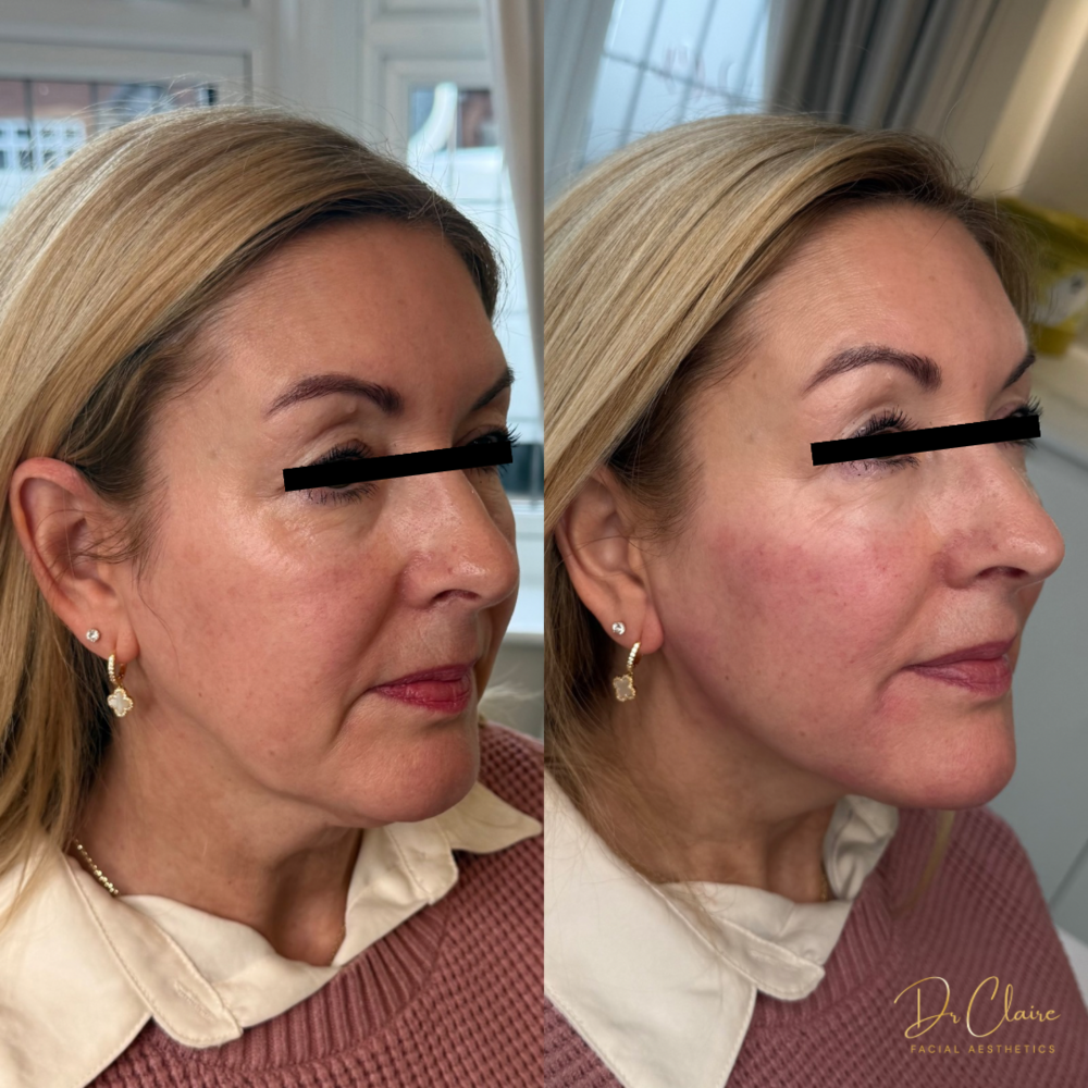 Transformations | Dr Claire Facial Aesthetics | Botox Chorley | Fillers Chorley | Aesthetics Chorley | Botox Treatments Chorley | Dermal Fillers Chorley | Aesthetic Enhancements Chorley