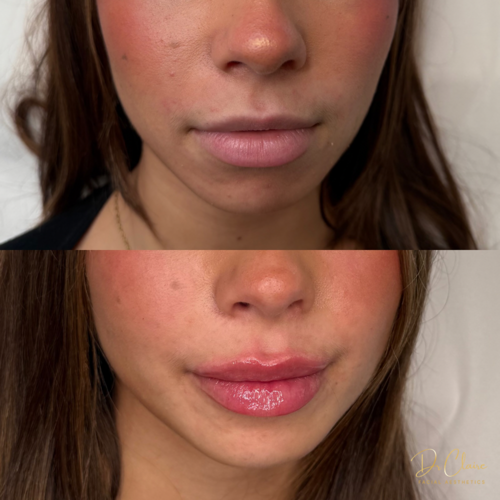 Transformations | Dr Claire Facial Aesthetics | Botox Chorley | Fillers Chorley | Aesthetics Chorley | Botox Treatments Chorley | Dermal Fillers Chorley | Aesthetic Enhancements Chorley