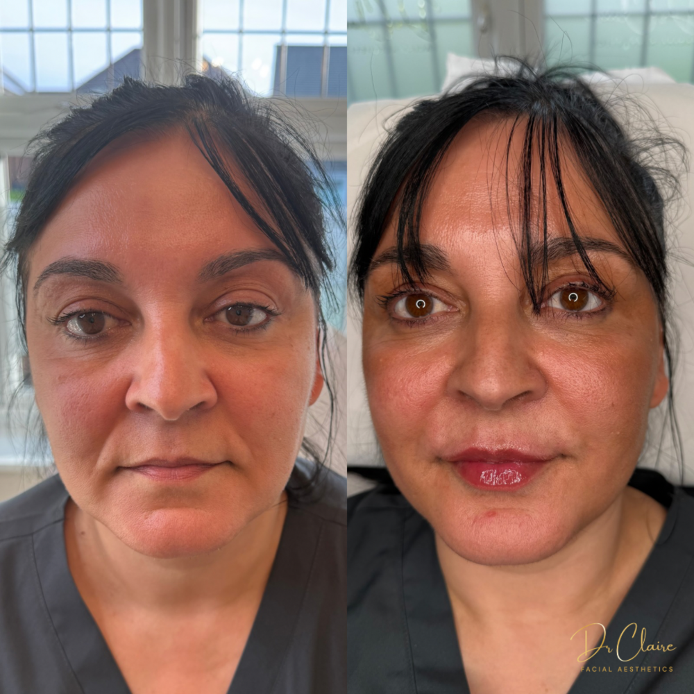 Transformations | Dr Claire Facial Aesthetics | Botox Chorley | Fillers Chorley | Aesthetics Chorley | Botox Treatments Chorley | Dermal Fillers Chorley | Aesthetic Enhancements Chorley
