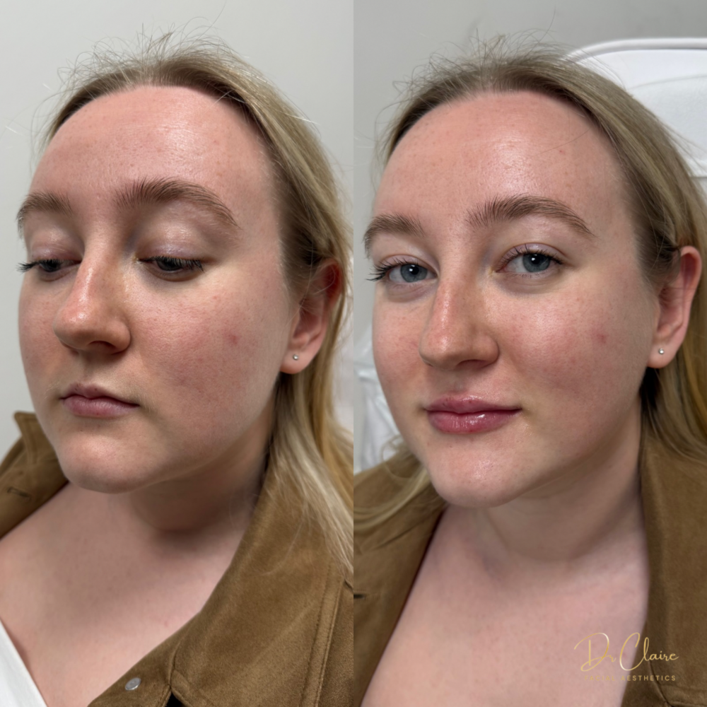 Transformations | Dr Claire Facial Aesthetics | Botox Chorley | Fillers Chorley | Aesthetics Chorley | Botox Treatments Chorley | Dermal Fillers Chorley | Aesthetic Enhancements Chorley