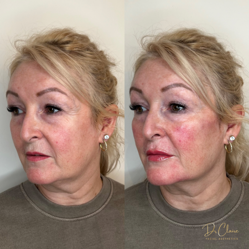 Transformations | Dr Claire Facial Aesthetics | Botox Chorley | Fillers Chorley | Aesthetics Chorley | Botox Treatments Chorley | Dermal Fillers Chorley | Aesthetic Enhancements Chorley