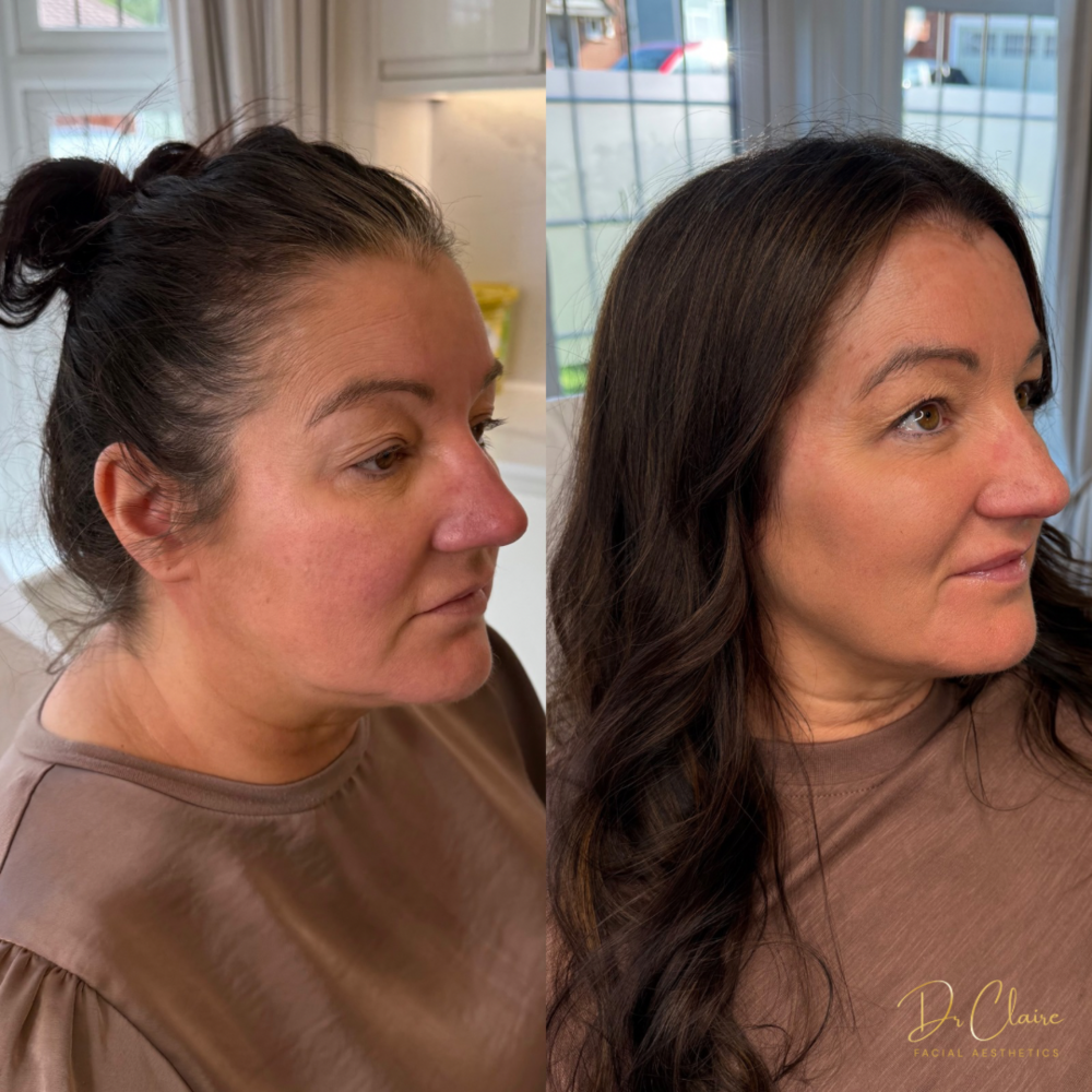 Transformations | Dr Claire Facial Aesthetics | Botox Chorley | Fillers Chorley | Aesthetics Chorley | Botox Treatments Chorley | Dermal Fillers Chorley | Aesthetic Enhancements Chorley