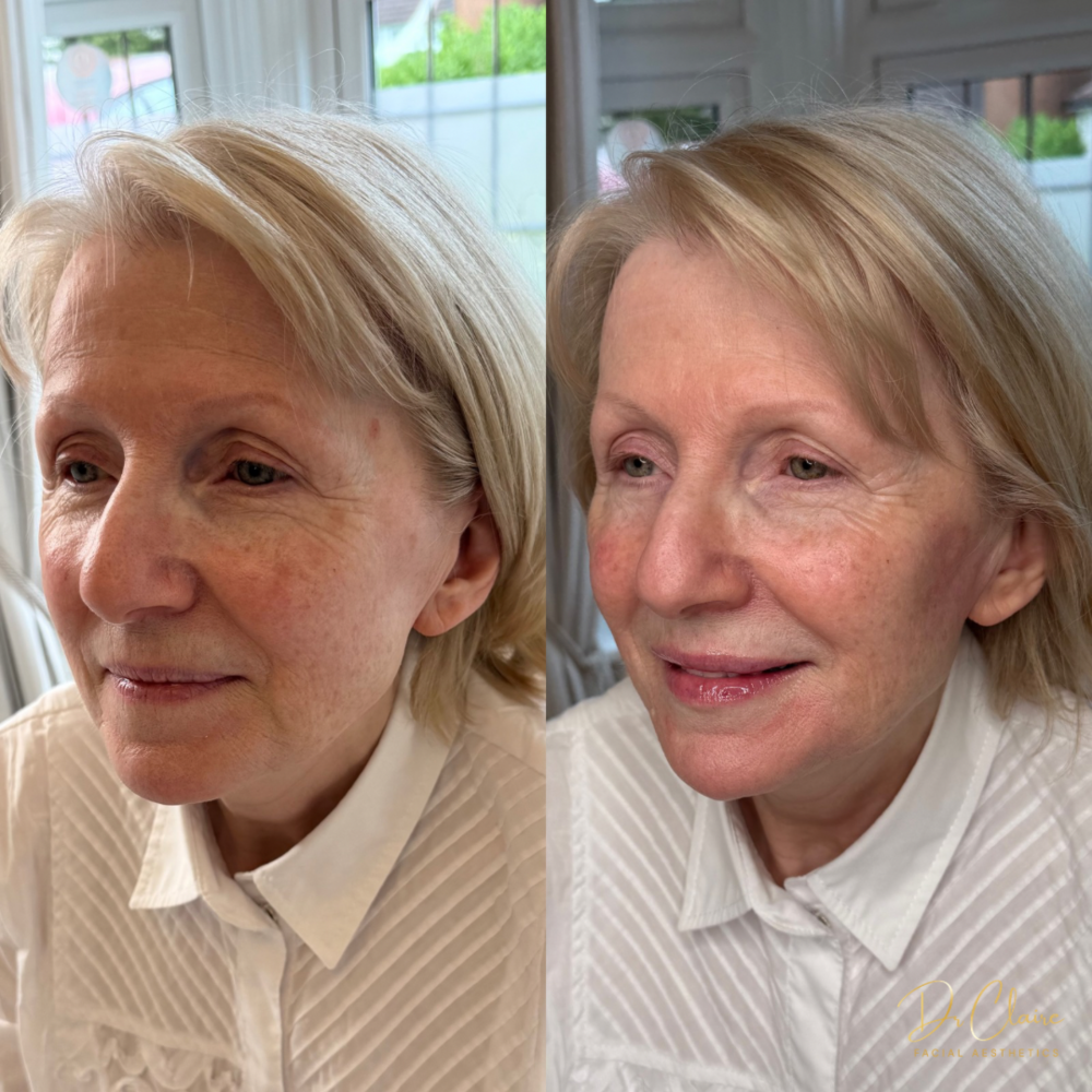 Transformations | Dr Claire Facial Aesthetics | Botox Chorley | Fillers Chorley | Aesthetics Chorley | Botox Treatments Chorley | Dermal Fillers Chorley | Aesthetic Enhancements Chorley