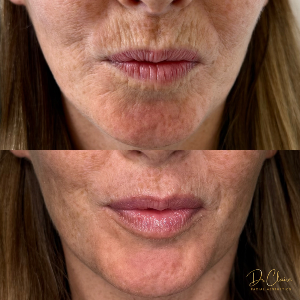 Transformations | Dr Claire Facial Aesthetics | Botox Chorley | Fillers Chorley | Aesthetics Chorley | Botox Treatments Chorley | Dermal Fillers Chorley | Aesthetic Enhancements Chorley