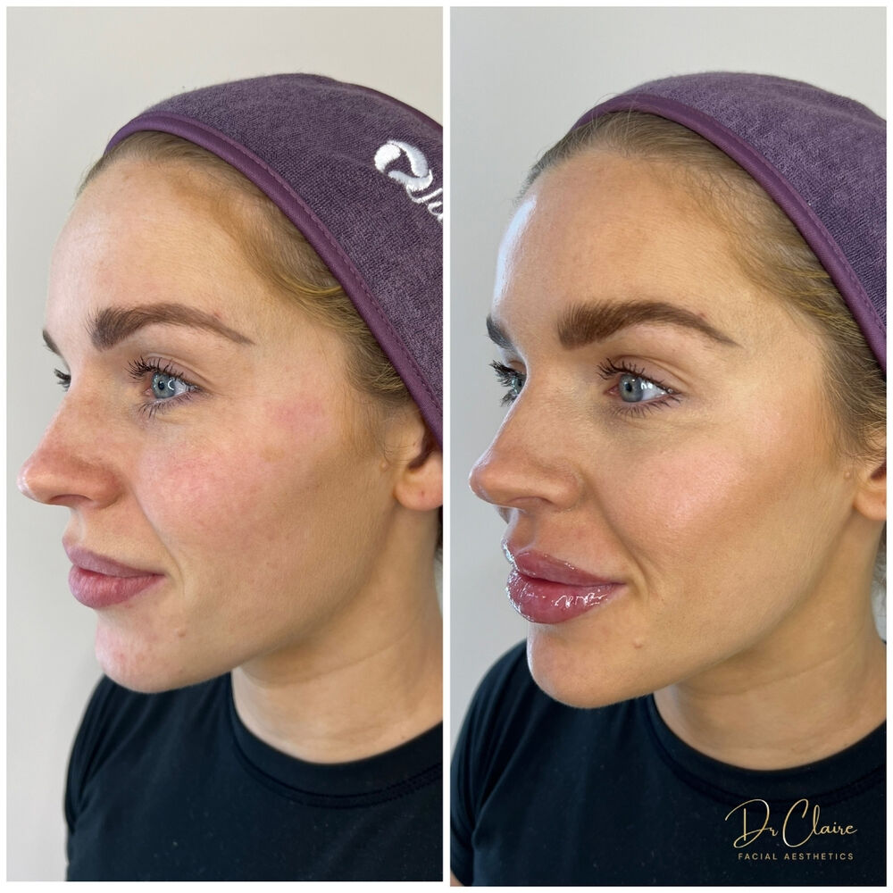 Transformations | Dr Claire Facial Aesthetics | Botox Chorley | Fillers Chorley | Aesthetics Chorley | Botox Treatments Chorley | Dermal Fillers Chorley | Aesthetic Enhancements Chorley