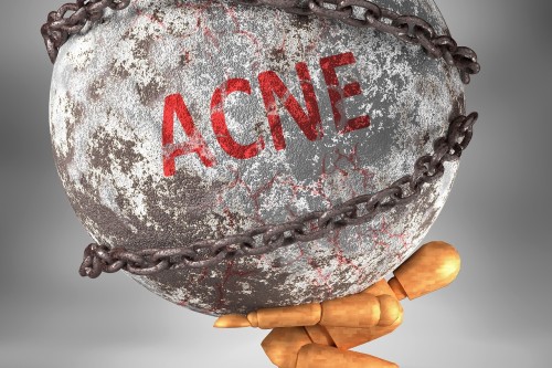 Acne Uncovered: How nutrition can help and the gut-skin axis.