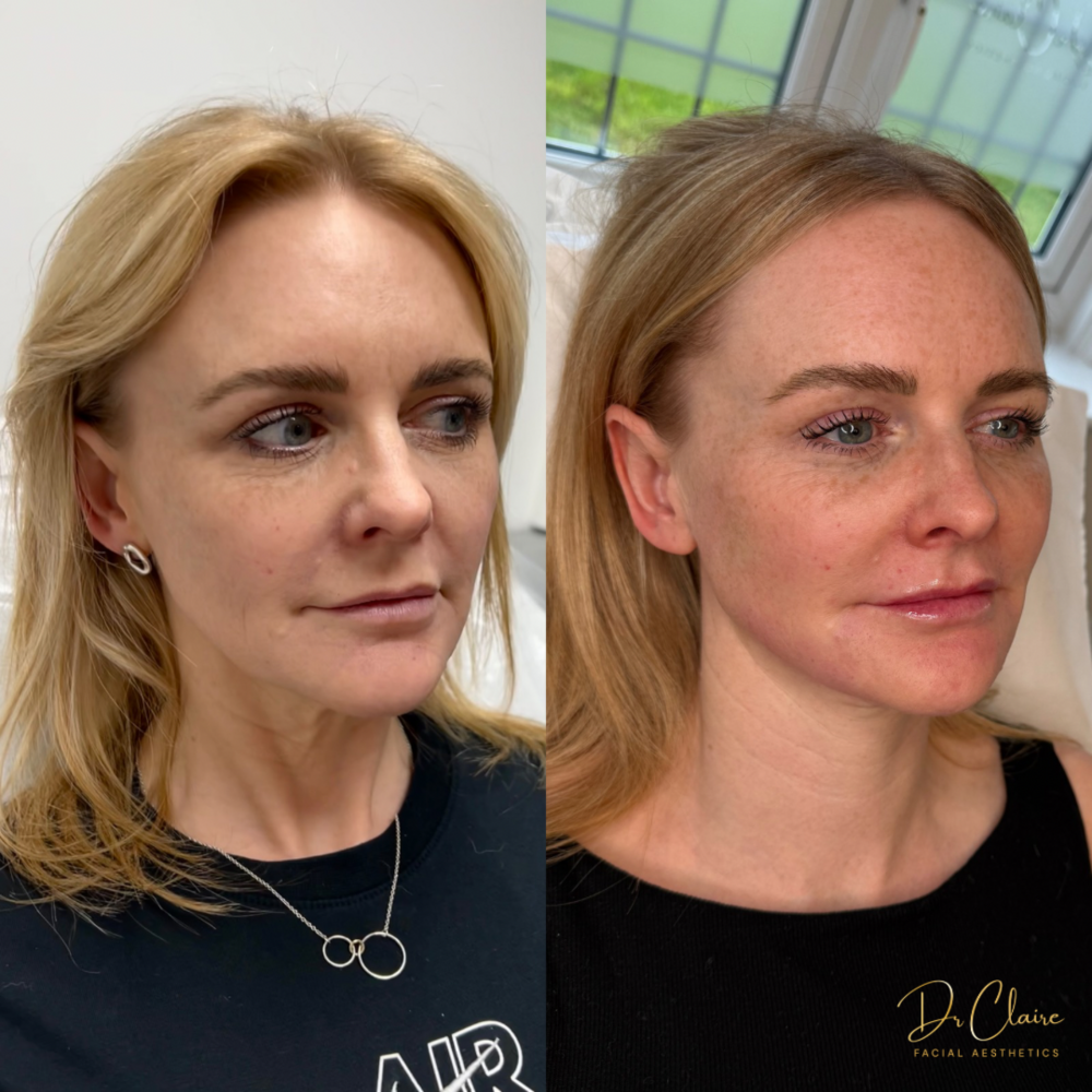 Transformations | Dr Claire Facial Aesthetics | Botox Chorley | Fillers Chorley | Aesthetics Chorley | Botox Treatments Chorley | Dermal Fillers Chorley | Aesthetic Enhancements Chorley