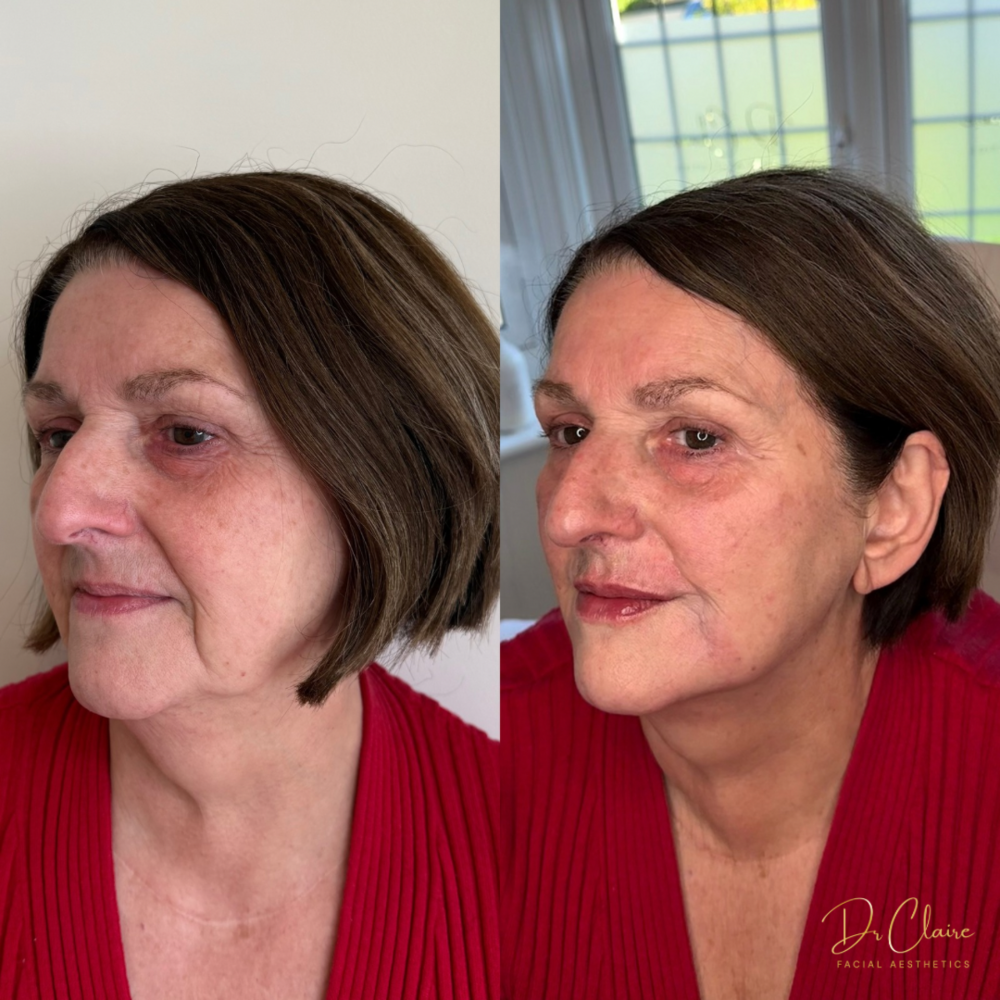 Transformations | Dr Claire Facial Aesthetics | Botox Chorley | Fillers Chorley | Aesthetics Chorley | Botox Treatments Chorley | Dermal Fillers Chorley | Aesthetic Enhancements Chorley