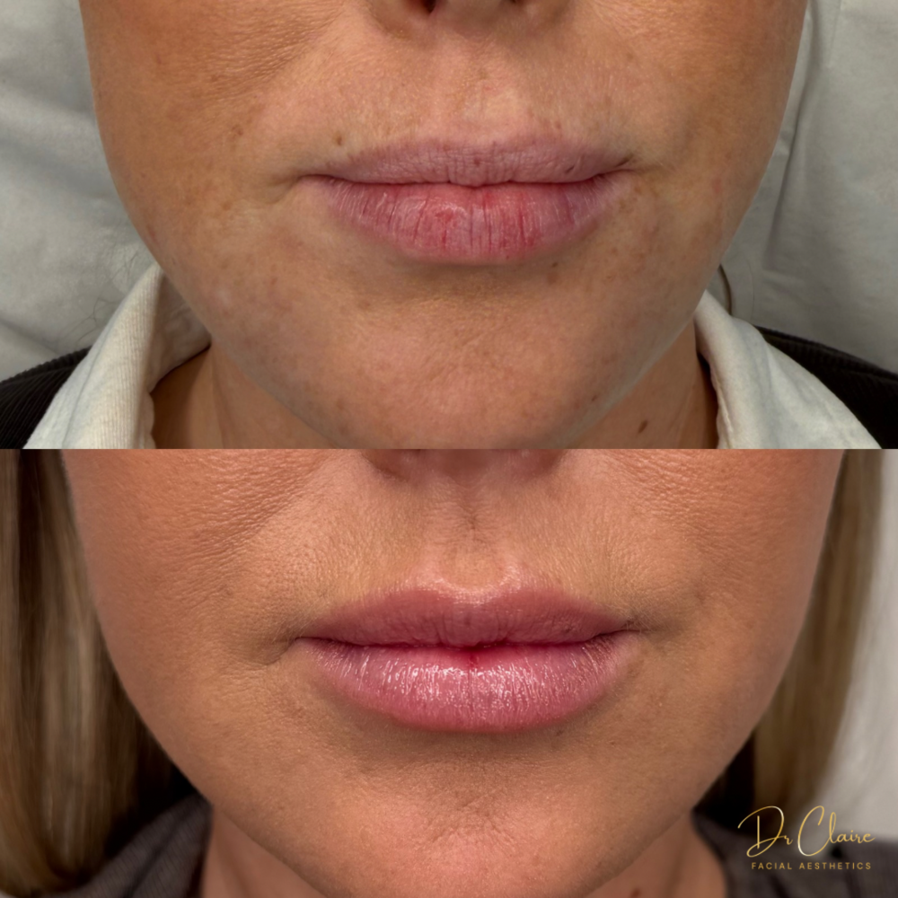 Transformations | Dr Claire Facial Aesthetics | Botox Chorley | Fillers Chorley | Aesthetics Chorley | Botox Treatments Chorley | Dermal Fillers Chorley | Aesthetic Enhancements Chorley