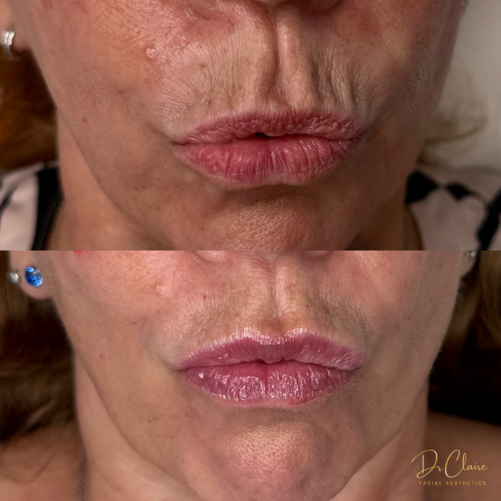 Transformations | Dr Claire Facial Aesthetics | Botox Chorley | Fillers Chorley | Aesthetics Chorley | Botox Treatments Chorley | Dermal Fillers Chorley | Aesthetic Enhancements Chorley