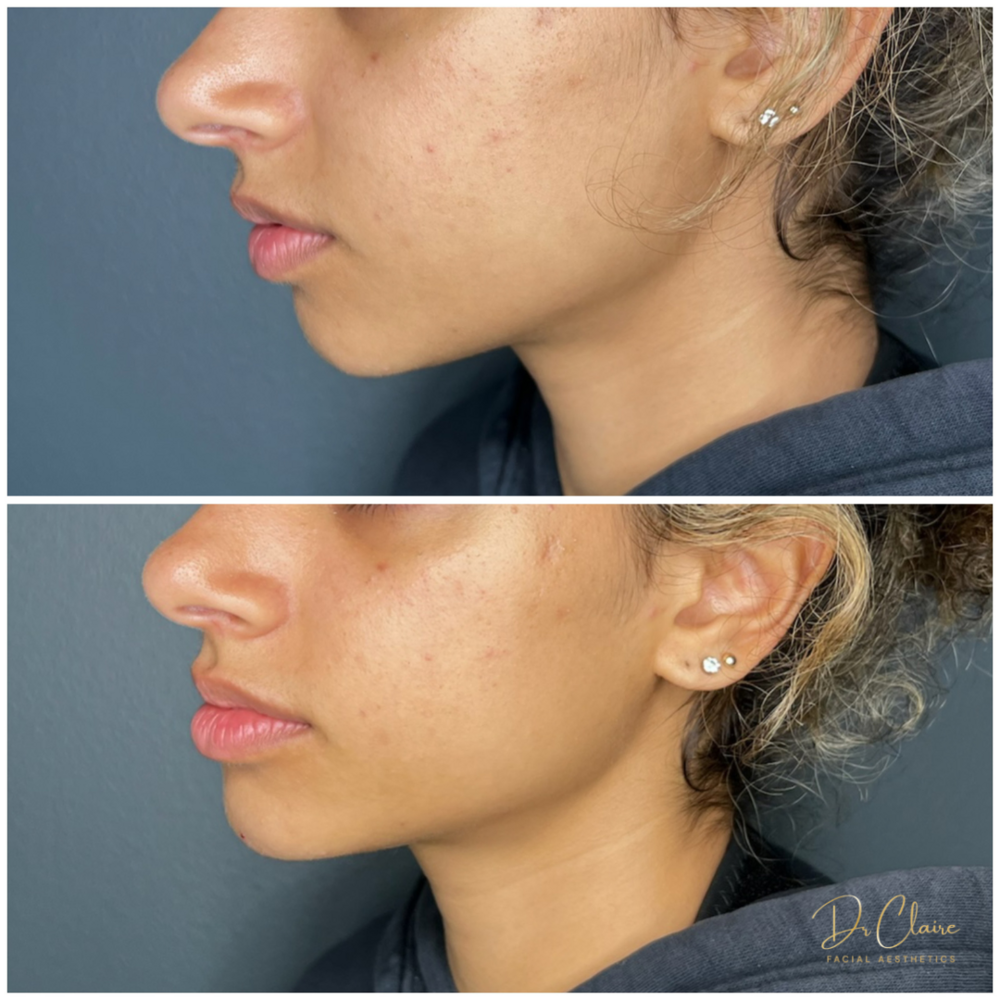 Transformations | Dr Claire Facial Aesthetics | Botox Chorley | Fillers Chorley | Aesthetics Chorley | Botox Treatments Chorley | Dermal Fillers Chorley | Aesthetic Enhancements Chorley