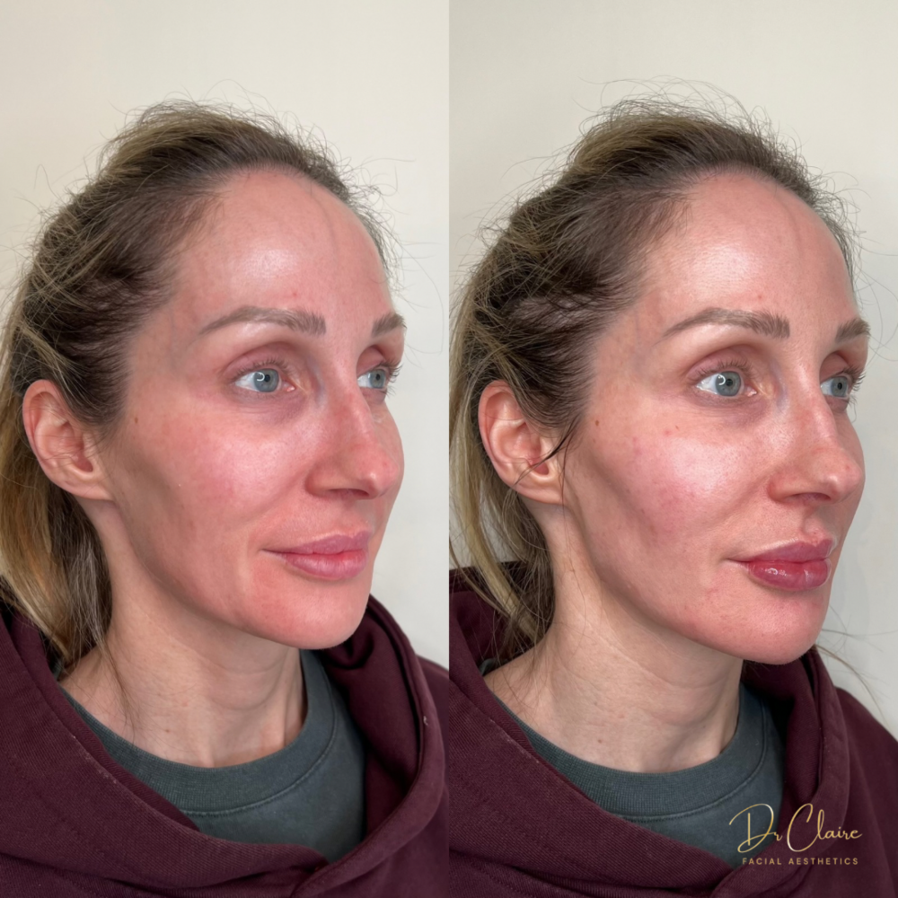 Transformations | Dr Claire Facial Aesthetics | Botox Chorley | Fillers Chorley | Aesthetics Chorley | Botox Treatments Chorley | Dermal Fillers Chorley | Aesthetic Enhancements Chorley