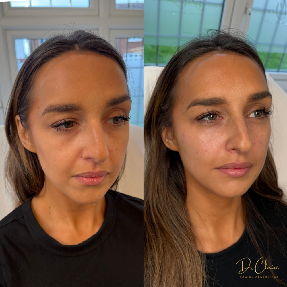 Transformations | Dr Claire Facial Aesthetics | Botox Chorley | Fillers Chorley | Aesthetics Chorley | Botox Treatments Chorley | Dermal Fillers Chorley | Aesthetic Enhancements Chorley