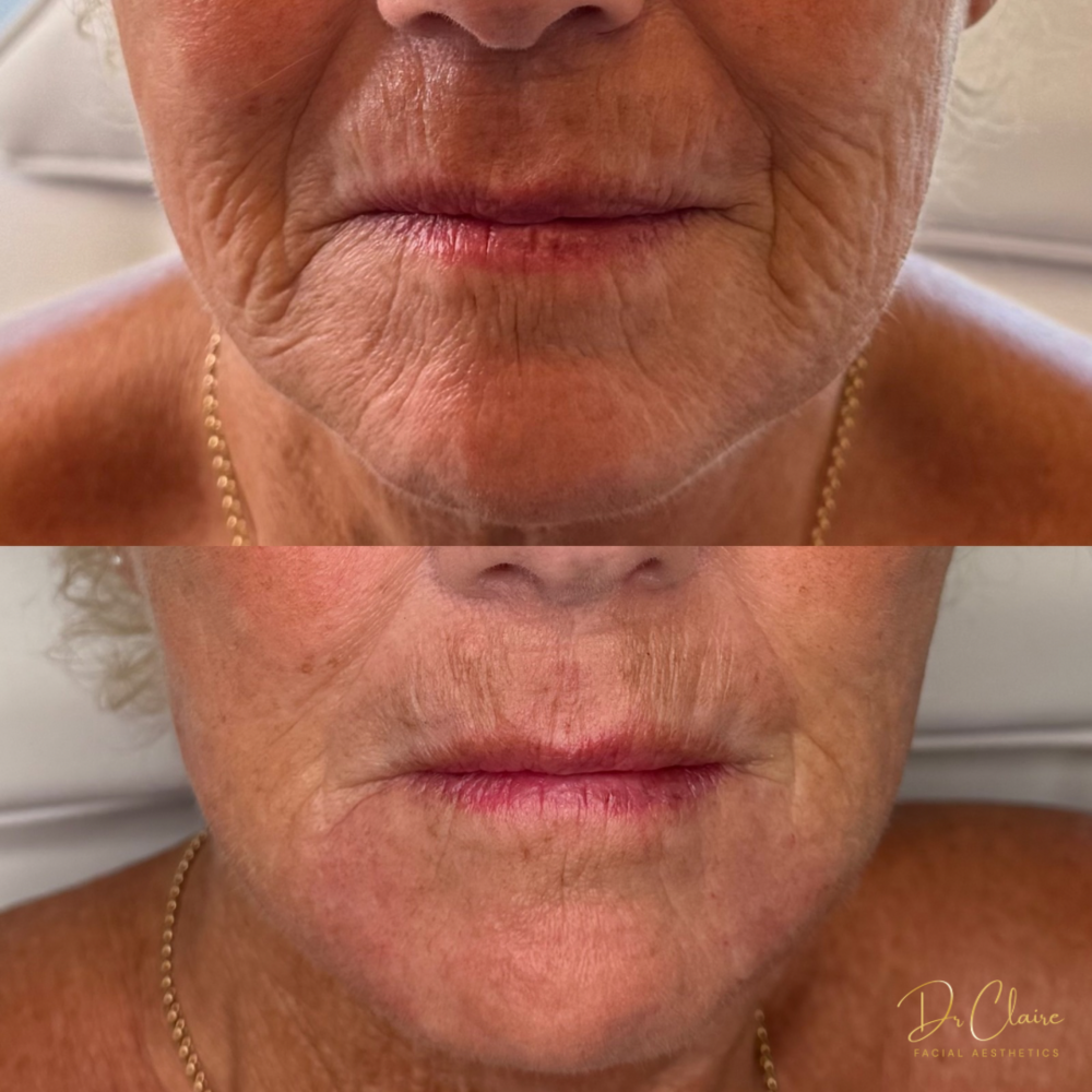 Transformations | Dr Claire Facial Aesthetics | Botox Chorley | Fillers Chorley | Aesthetics Chorley | Botox Treatments Chorley | Dermal Fillers Chorley | Aesthetic Enhancements Chorley