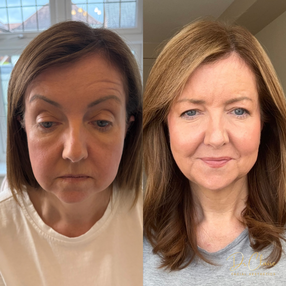 Transformations | Dr Claire Facial Aesthetics | Botox Chorley | Fillers Chorley | Aesthetics Chorley | Botox Treatments Chorley | Dermal Fillers Chorley | Aesthetic Enhancements Chorley