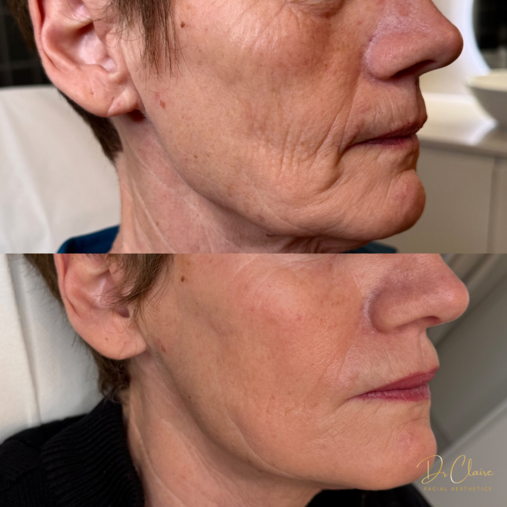 Transformations | Dr Claire Facial Aesthetics | Botox Chorley | Fillers Chorley | Aesthetics Chorley | Botox Treatments Chorley | Dermal Fillers Chorley | Aesthetic Enhancements Chorley