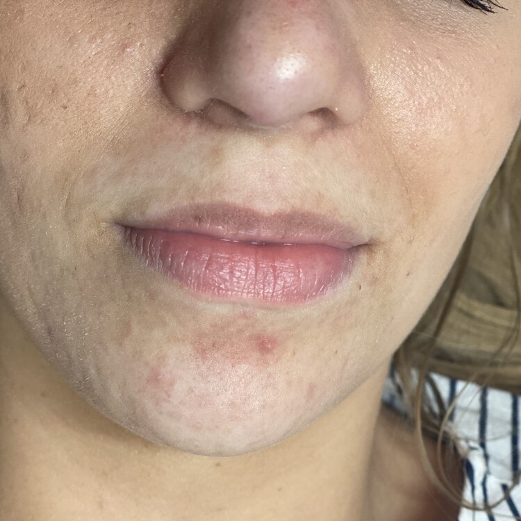 Before & After Results