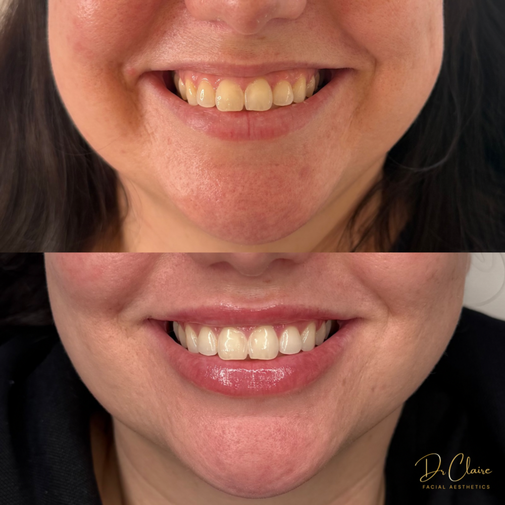 Transformations | Dr Claire Facial Aesthetics | Botox Chorley | Fillers Chorley | Aesthetics Chorley | Botox Treatments Chorley | Dermal Fillers Chorley | Aesthetic Enhancements Chorley