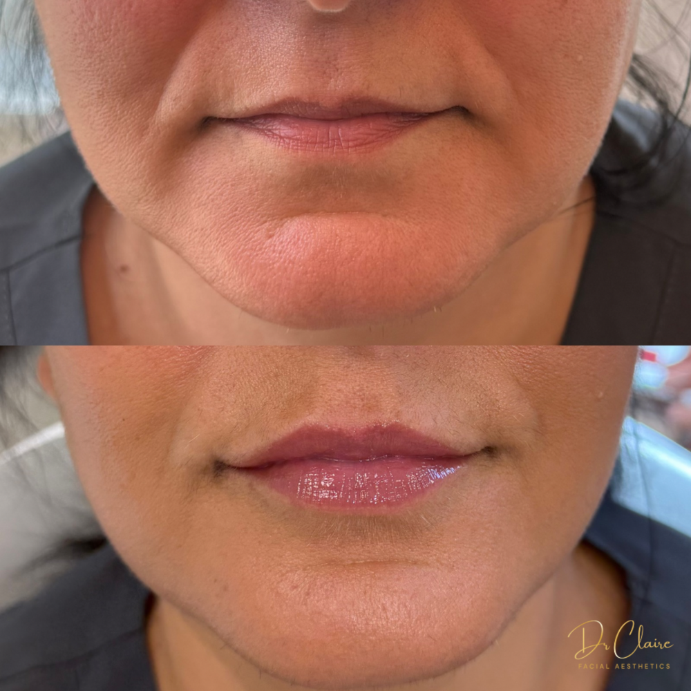 Transformations | Dr Claire Facial Aesthetics | Botox Chorley | Fillers Chorley | Aesthetics Chorley | Botox Treatments Chorley | Dermal Fillers Chorley | Aesthetic Enhancements Chorley