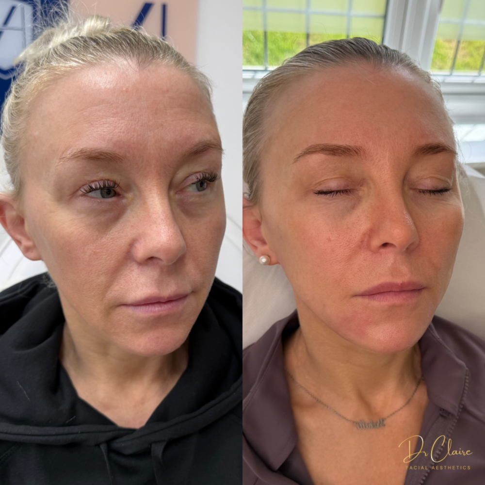 Transformations | Dr Claire Facial Aesthetics | Botox Chorley | Fillers Chorley | Aesthetics Chorley | Botox Treatments Chorley | Dermal Fillers Chorley | Aesthetic Enhancements Chorley