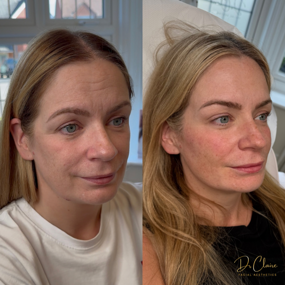 Transformations | Dr Claire Facial Aesthetics | Botox Chorley | Fillers Chorley | Aesthetics Chorley | Botox Treatments Chorley | Dermal Fillers Chorley | Aesthetic Enhancements Chorley