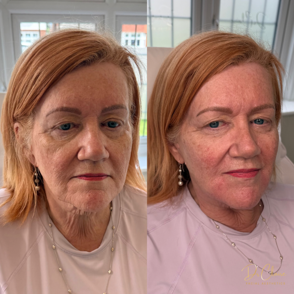 Transformations | Dr Claire Facial Aesthetics | Botox Chorley | Fillers Chorley | Aesthetics Chorley | Botox Treatments Chorley | Dermal Fillers Chorley | Aesthetic Enhancements Chorley