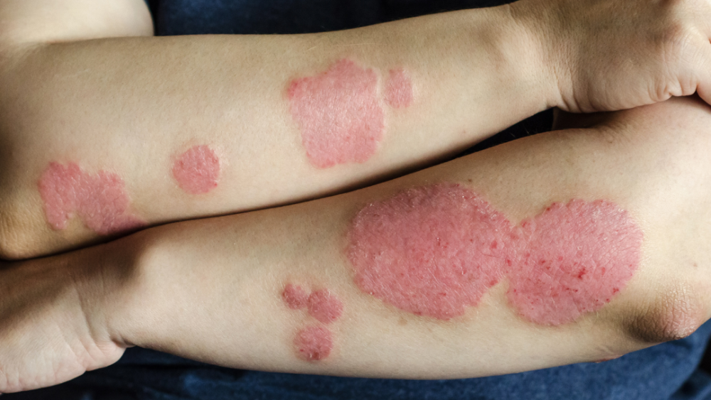 Underlying Causes of Psoriasis