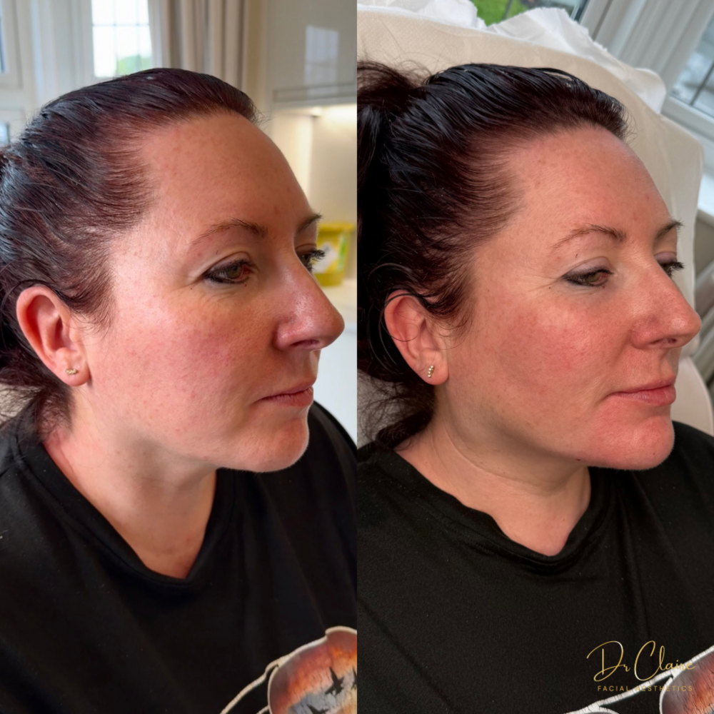 Transformations | Dr Claire Facial Aesthetics | Botox Chorley | Fillers Chorley | Aesthetics Chorley | Botox Treatments Chorley | Dermal Fillers Chorley | Aesthetic Enhancements Chorley