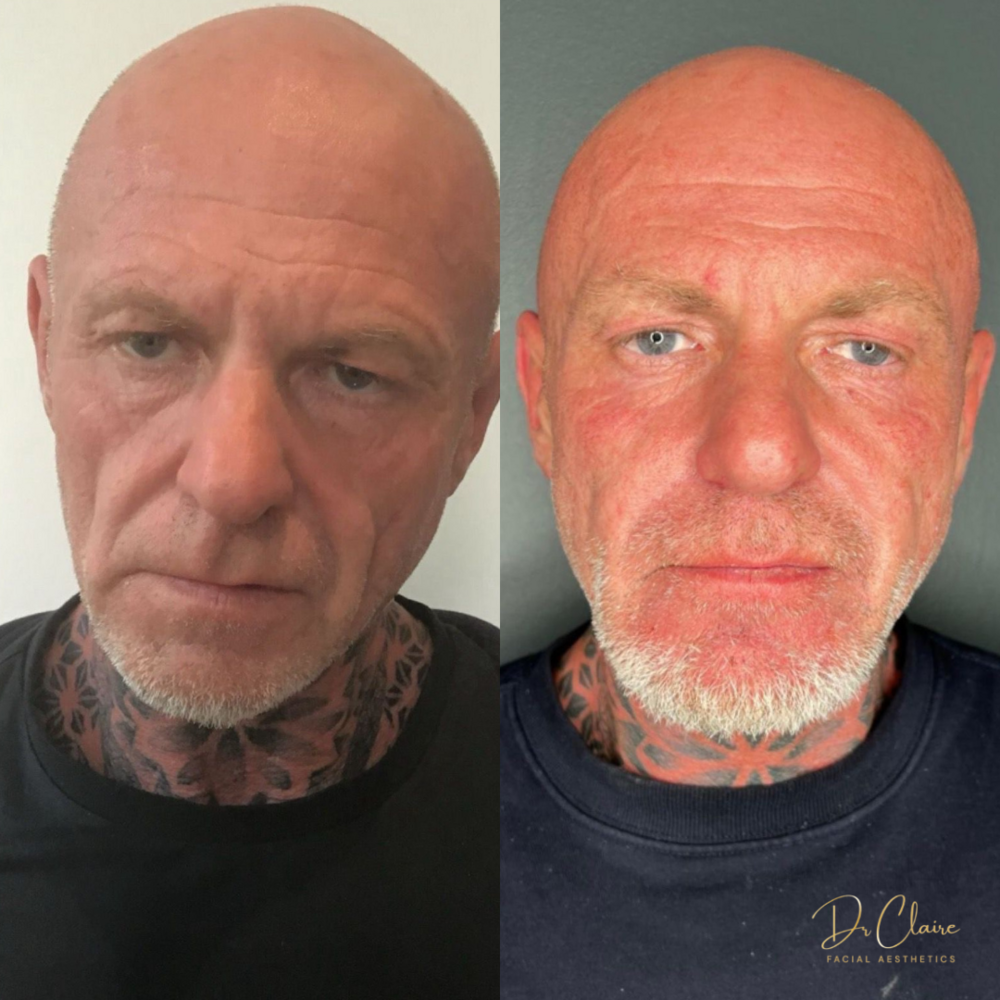 Transformations | Dr Claire Facial Aesthetics | Botox Chorley | Fillers Chorley | Aesthetics Chorley | Botox Treatments Chorley | Dermal Fillers Chorley | Aesthetic Enhancements Chorley