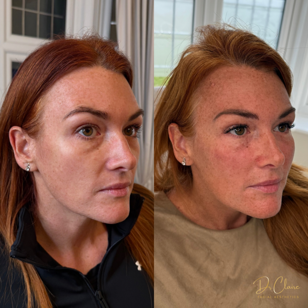 Transformations | Dr Claire Facial Aesthetics | Botox Chorley | Fillers Chorley | Aesthetics Chorley | Botox Treatments Chorley | Dermal Fillers Chorley | Aesthetic Enhancements Chorley