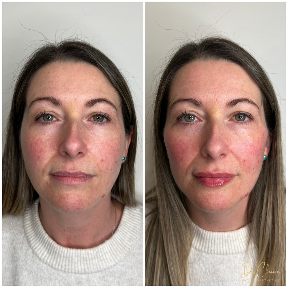 Transformations | Dr Claire Facial Aesthetics | Botox Chorley | Fillers Chorley | Aesthetics Chorley | Botox Treatments Chorley | Dermal Fillers Chorley | Aesthetic Enhancements Chorley
