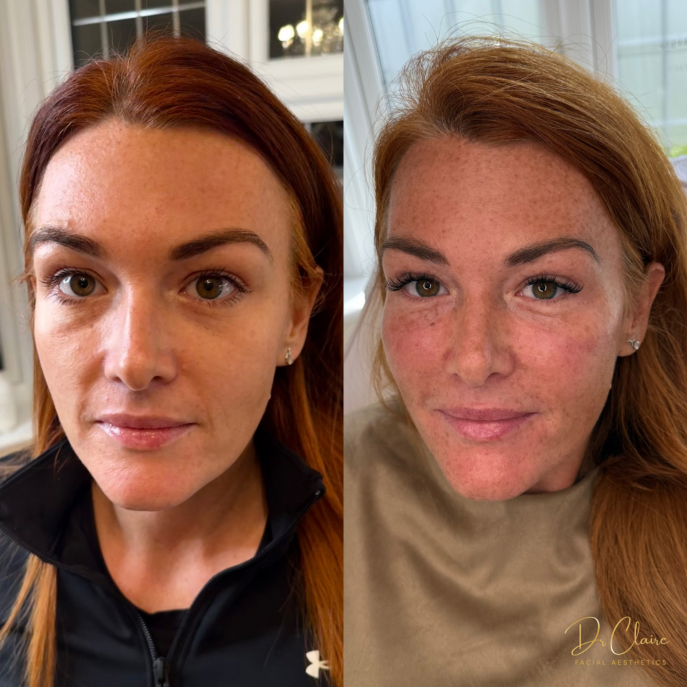 Transformations | Dr Claire Facial Aesthetics | Botox Chorley | Fillers Chorley | Aesthetics Chorley | Botox Treatments Chorley | Dermal Fillers Chorley | Aesthetic Enhancements Chorley