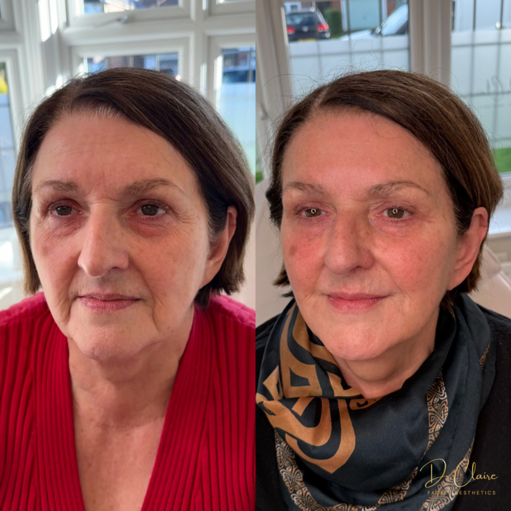 Transformations | Dr Claire Facial Aesthetics | Botox Chorley | Fillers Chorley | Aesthetics Chorley | Botox Treatments Chorley | Dermal Fillers Chorley | Aesthetic Enhancements Chorley